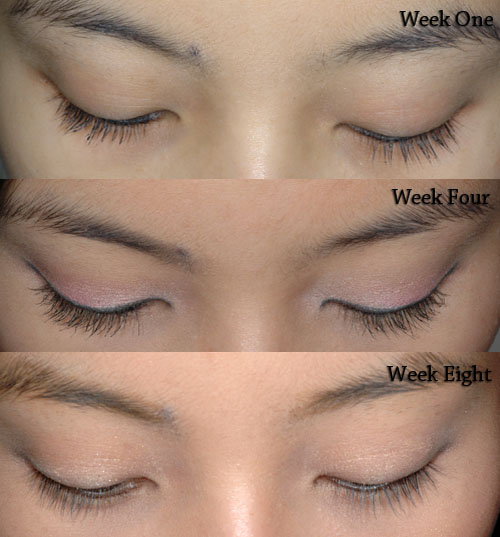 latisse eye discoloration